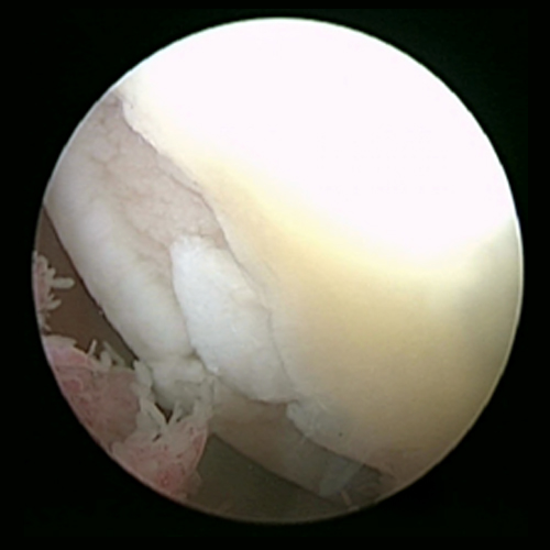 Endoskopische Aufnahme mit sichtbaren Knorpelschäden: ausgefranste Ränder und unebene Oberfläche